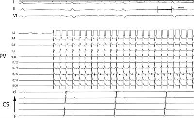 Pulmonary vein capture is a predictor for long-term success of stand-alone pulmonary vein isolation with cryoballoon ablation in patients with persistent atrial fibrillation